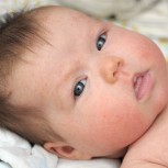 Is Baby Acne Common Among Newborns?