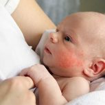 Baby Eczema Treatment