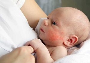 Baby Eczema Treatment