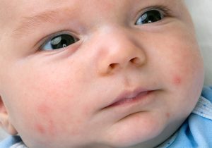 Newborn baby acne: Cause and treatment