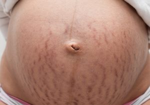 Top Tips On Avoiding Stretch Marks