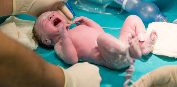 Nuchal cord: What to know if the umbilical cord is around baby’s neck